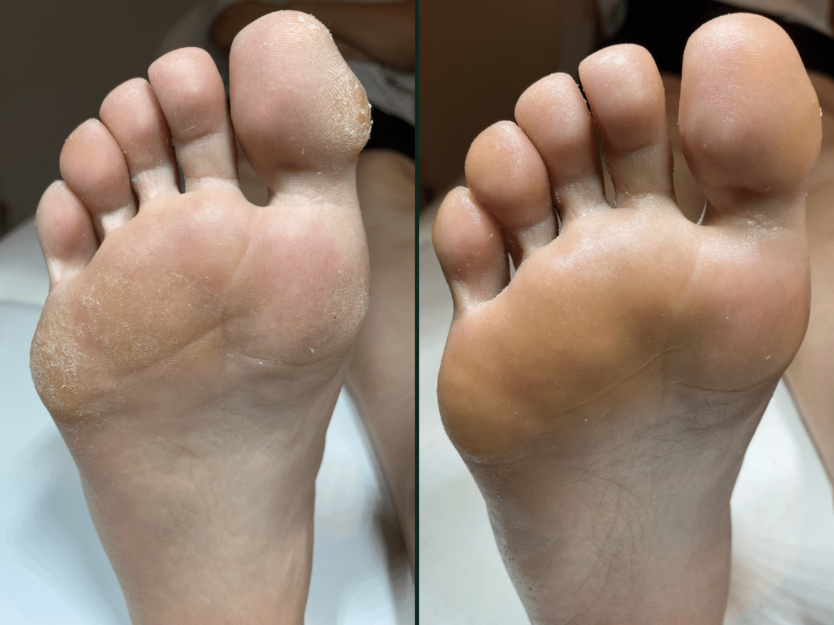 Pedicure podologiczny a kosmetyczny – poznaj różnice i zadbaj o zdrowie swoich stóp!