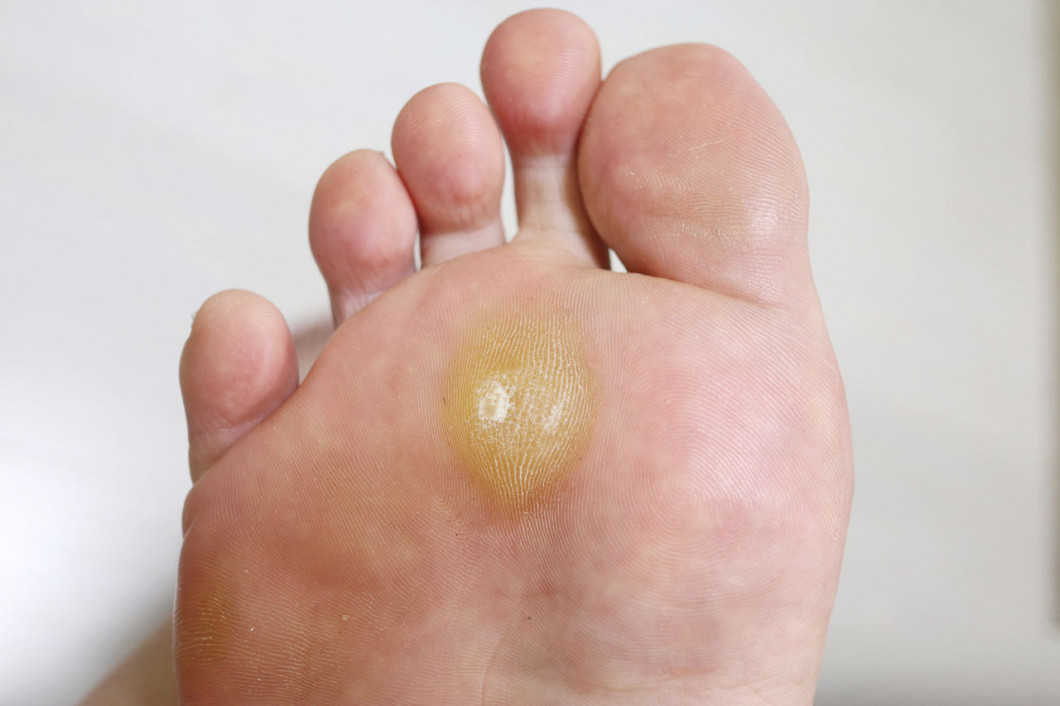 Co robić, gdy podczas wędrówki pojawi się odcisk lub otarcie na stopie?