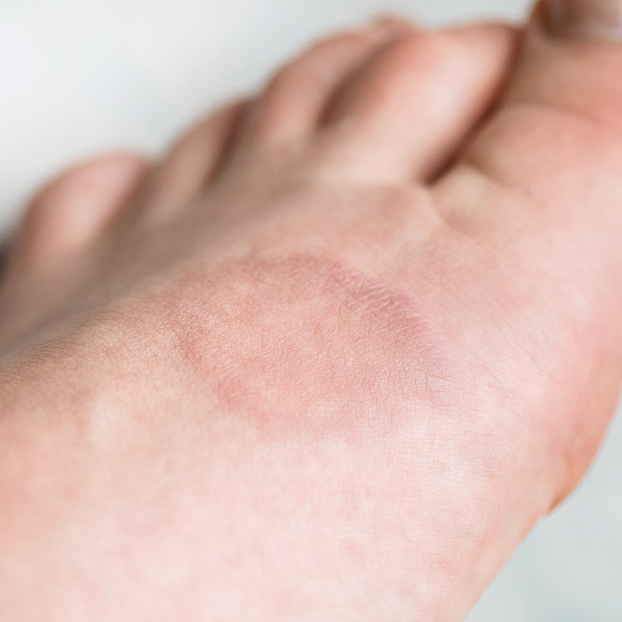 Czym jest ziarniniak obrączkowaty?