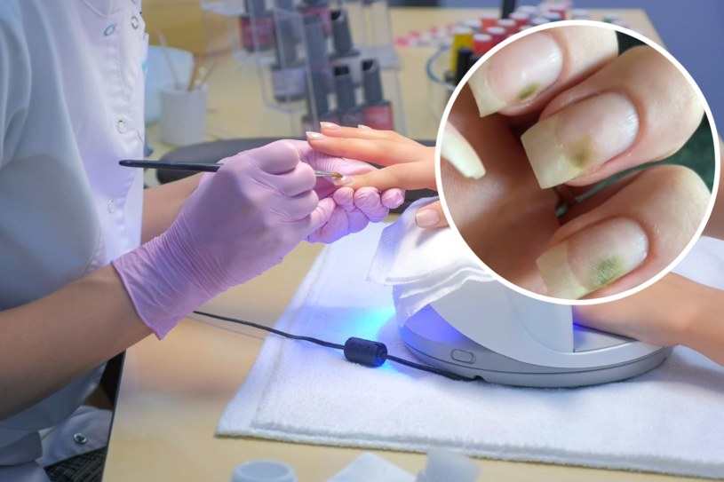 Pałeczka ropy błękitnej – wyzwanie w praktyce podologicznej