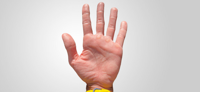 Jak dbać o skórę dłoni zimą?